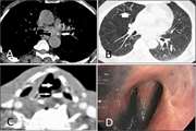 Anthracosis, a Distinct Cause of Vocal Fold Paralysis: Case Series